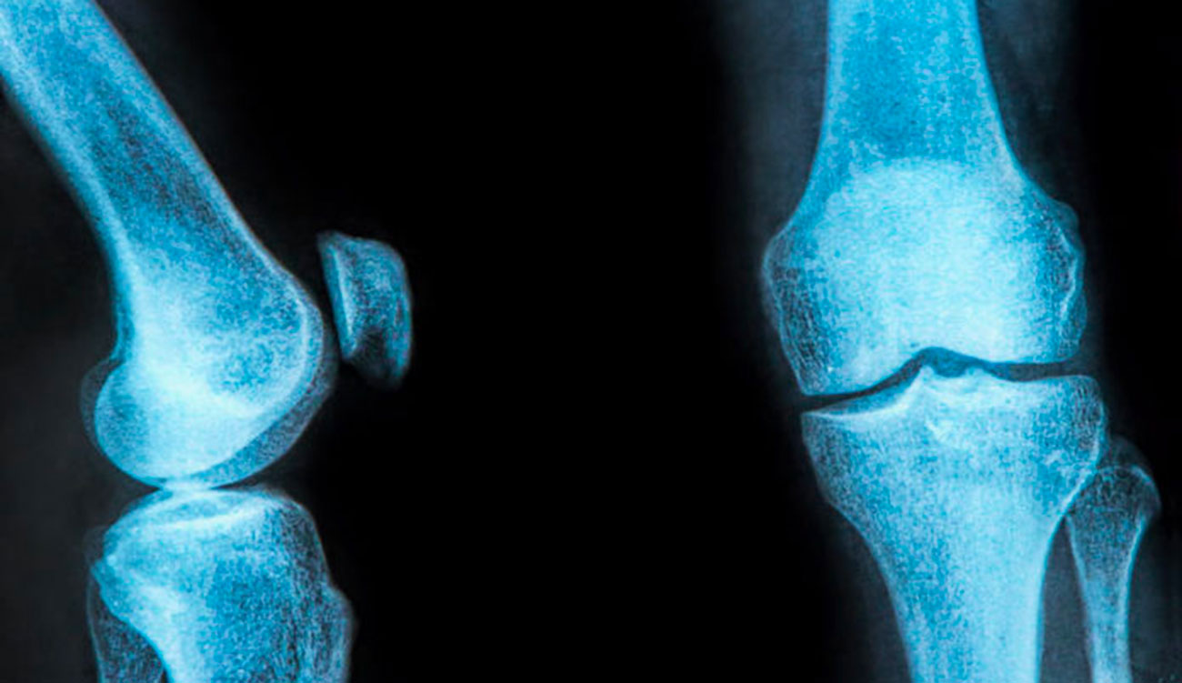 25 % des femmes de plus de 45 ans exposées au risque d&rsquo;ostéoporose