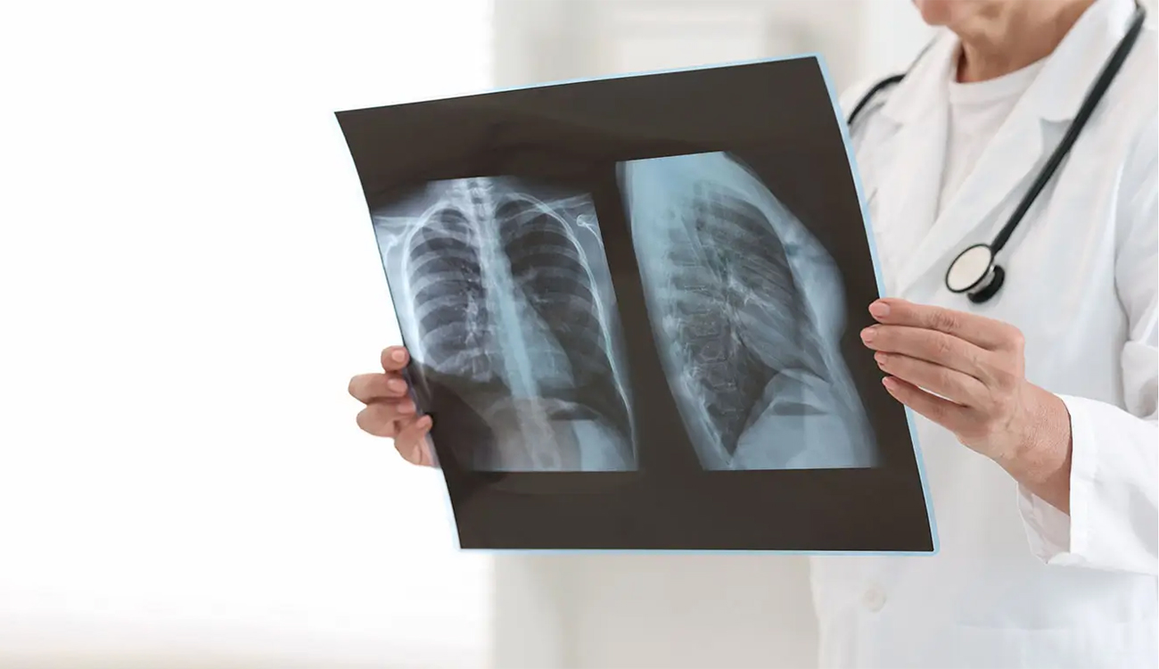 Cancer du poumon : 3000 nouveaux cas par an en...