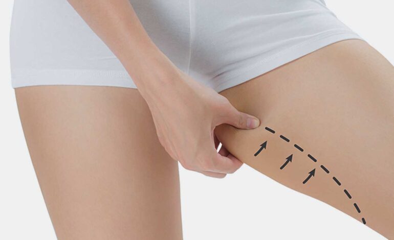 Cruroplastie : Lignes sublimées, aisance retrouvée