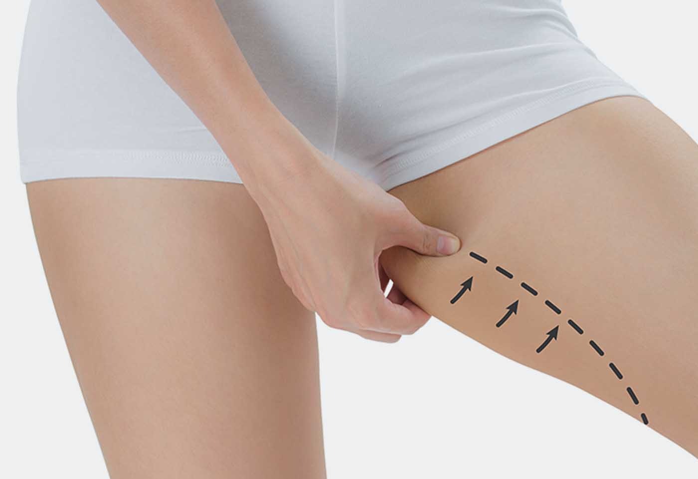 Cruroplastie : Lignes sublimées, aisance retrouvée