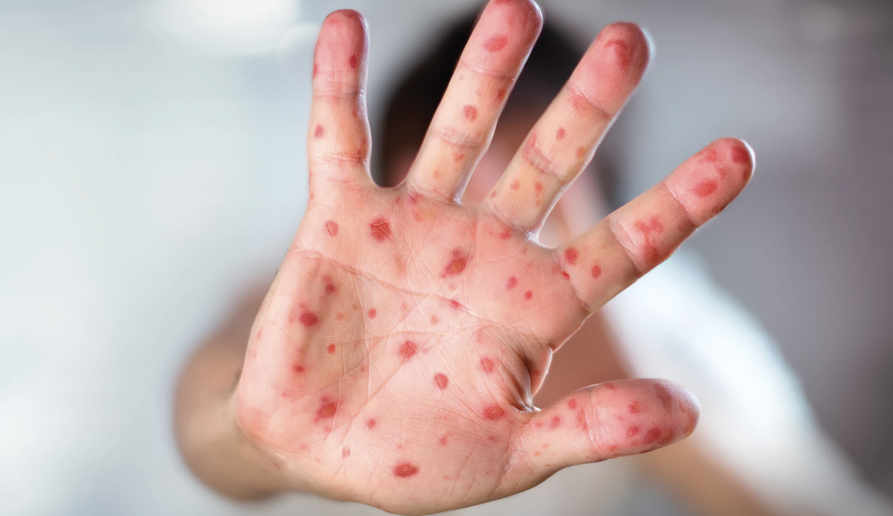 Rougeole chez les enfants : l’OMS appelle à la vaccination...