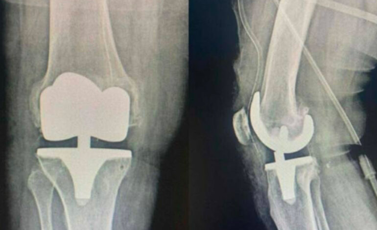 Jendouba : une première opération de prothèse totale du genou réussie à l’hôpital régional